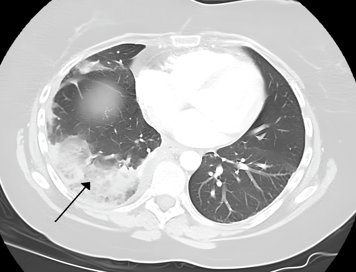    Гибель тканей легкого из-за тромбоэмболии легочной артерии / © James Heilman, MD, en.wikipedia.org