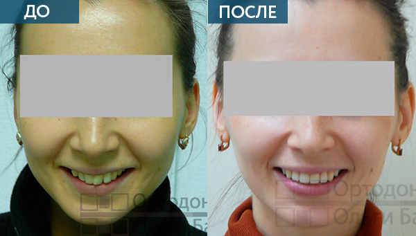 Лечение с помощью аппарата Гербста до и после