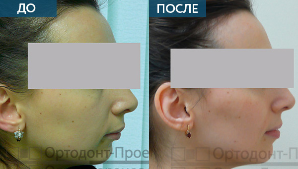 Исправление прикуса в Москве ДО и ПОСЛЕ