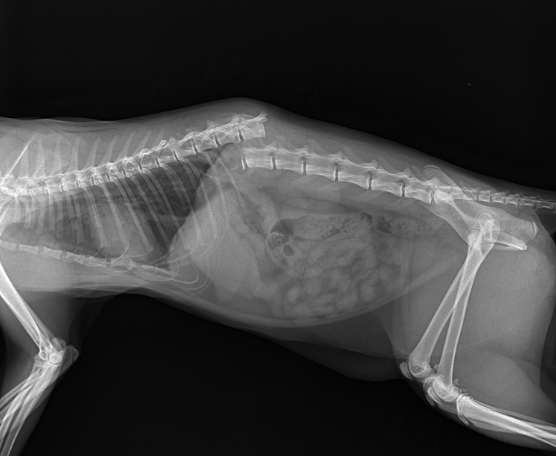 Перелом позвоночника, полученный при падении с большой высоты