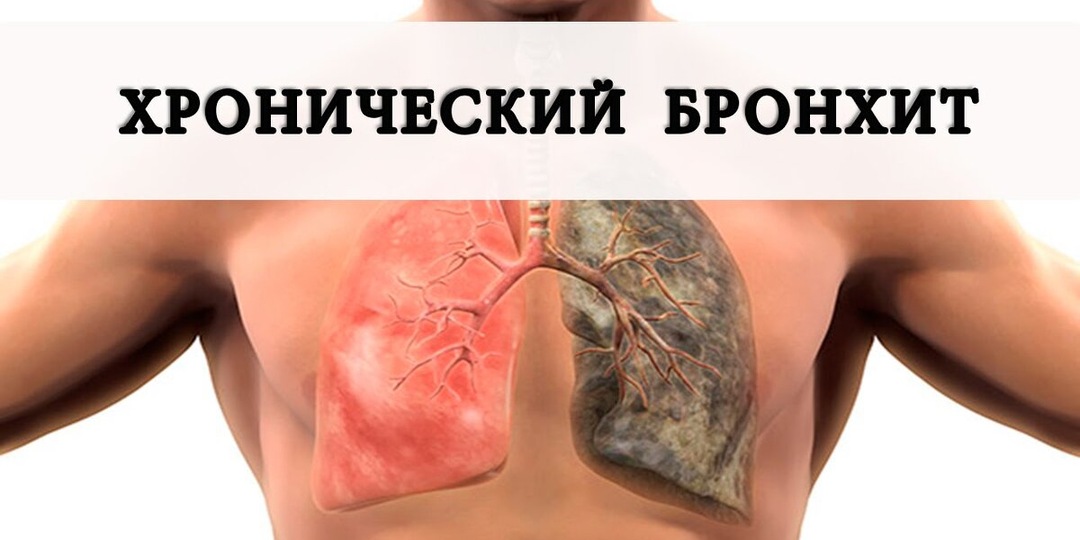 Кашель больше 7 дней? Возможно, у вас начинается Бронхит