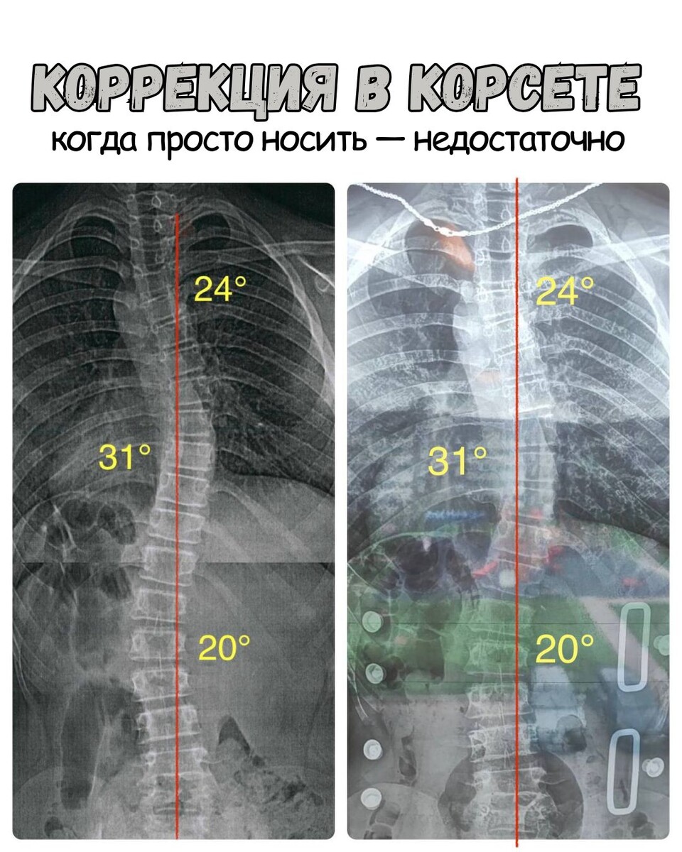 🎯 Коррекция в корсете: когда просто носить — недостаточно