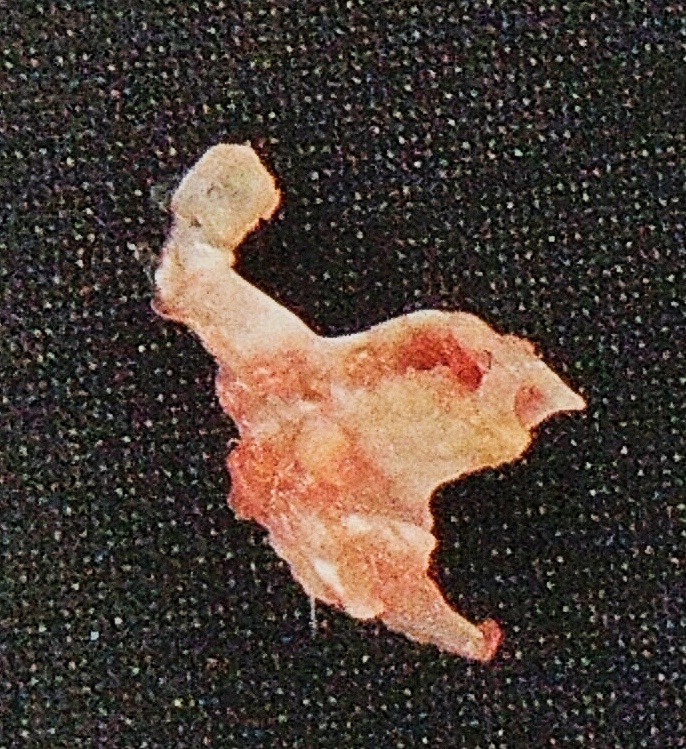 Петрификат мягких тканей. Увеличение.