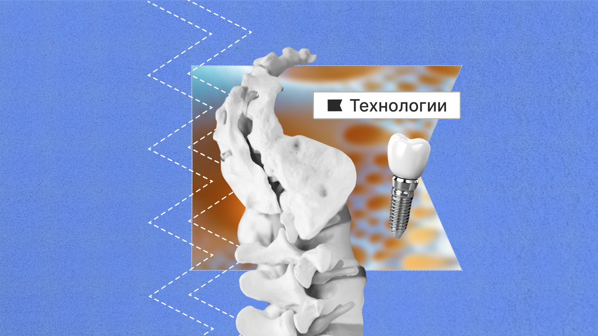 Ученые Политеха Петра разработали новый материал для медицинских имплантатов.