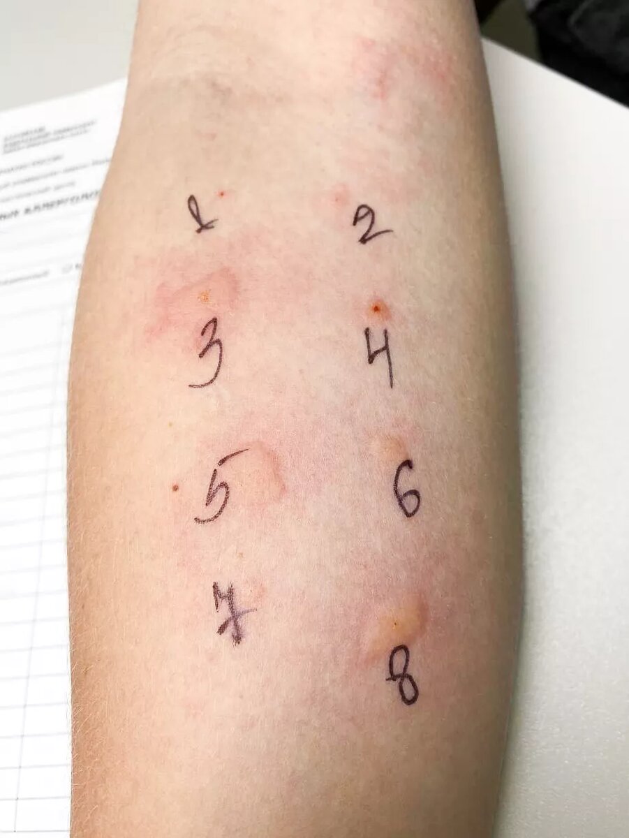 Аллергологические пробы пациента с аллергией на рыбу: № 1 — отрицательный контроль, № 2 — положительный контроль, № 3 — треска, № 5 — карп, № 8 — семга