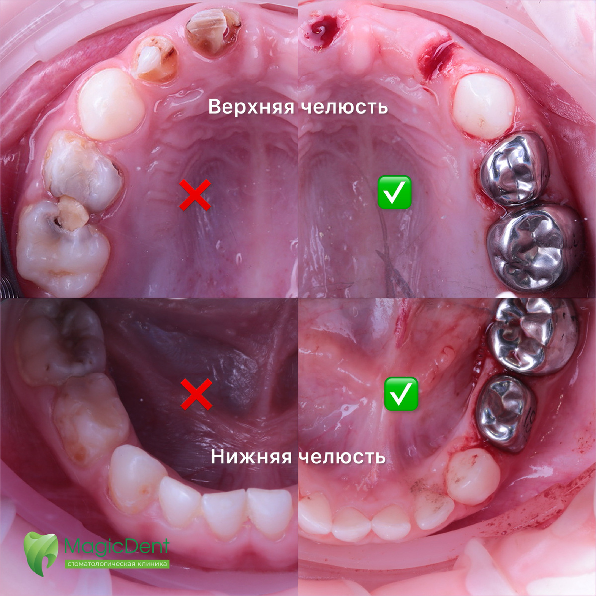 На фото показано левая половина полости рта до лечения и правая половина полости рта после лечения в условиях общей анестезии