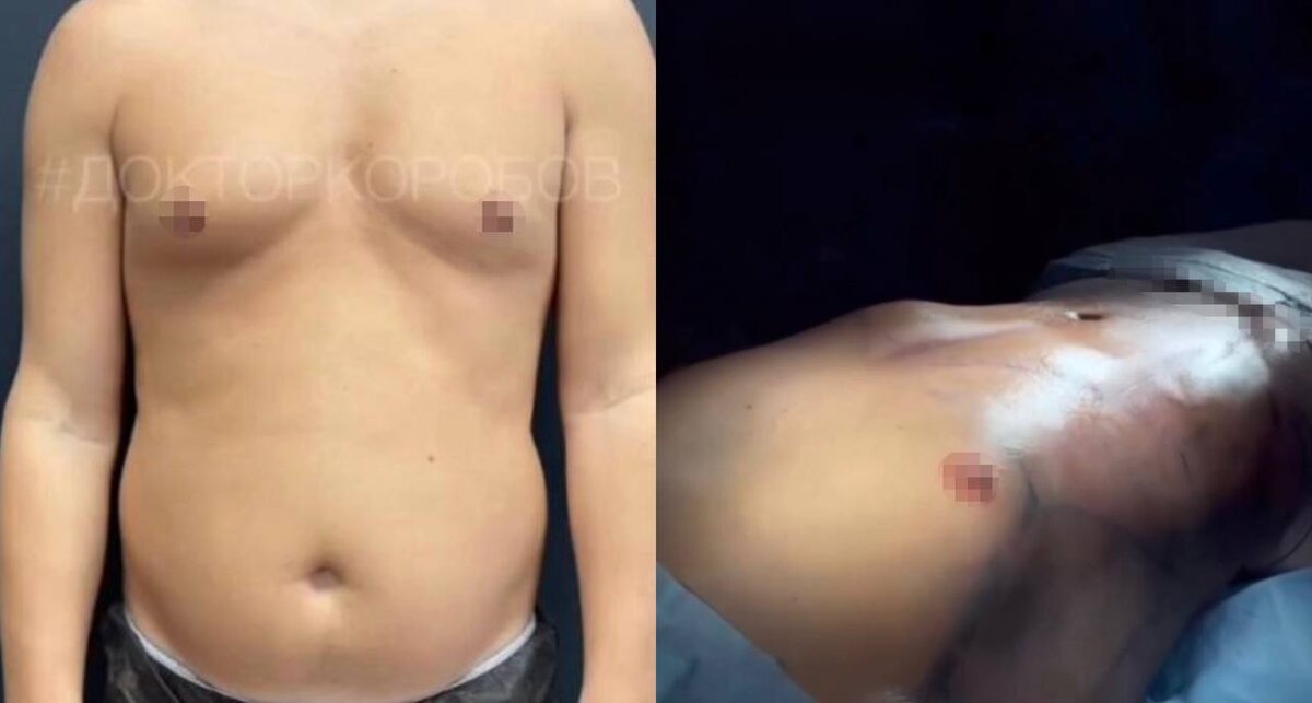 Липосакция живота с прорисовкой спортивных линий, липосакция пояснично-боковых зон, спины и груди. Результат сразу после операции