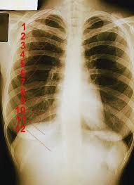 Женская рентгенограмма, стрелки указывают на задние дуги соответствующих рёбер.
