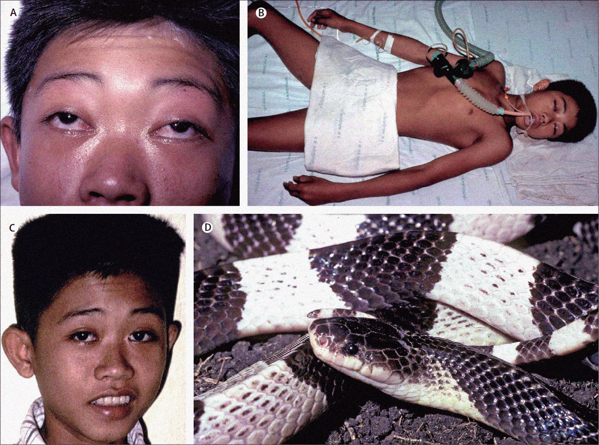 Эффект парализации от укуса змеи.