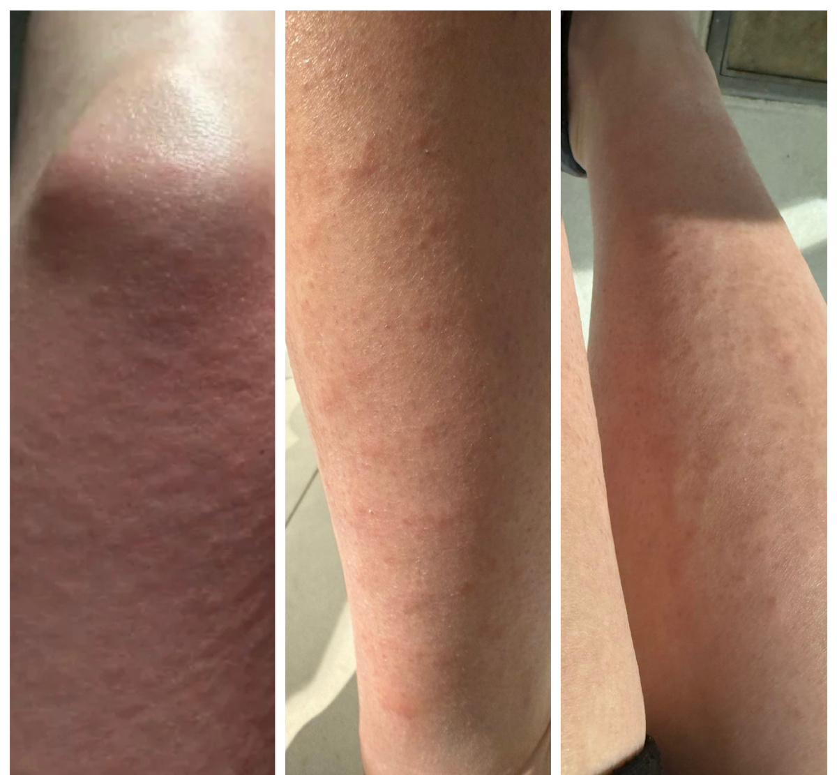 Фолликулярный оттек 