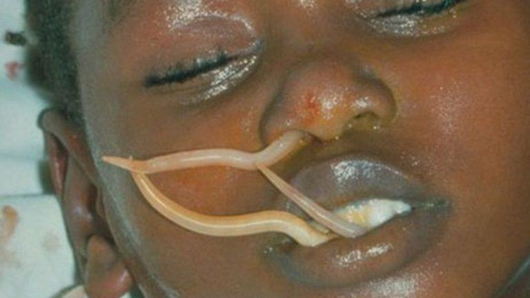 Да, да, да. Неудовлетворительная санитария, символом которой являются дети Африки, действительно является главным фактором заражения глистами.