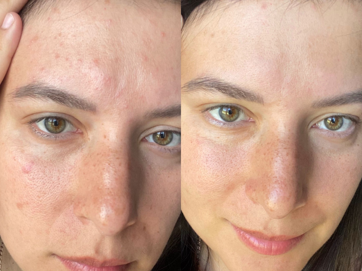 до/после ухода с правильной схемой (результат всего за неделю)