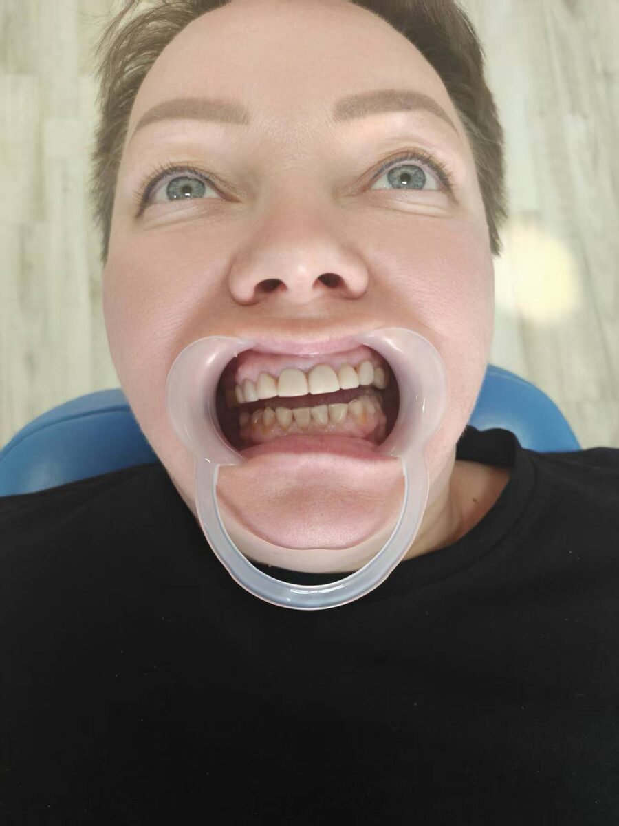 До протезирования.