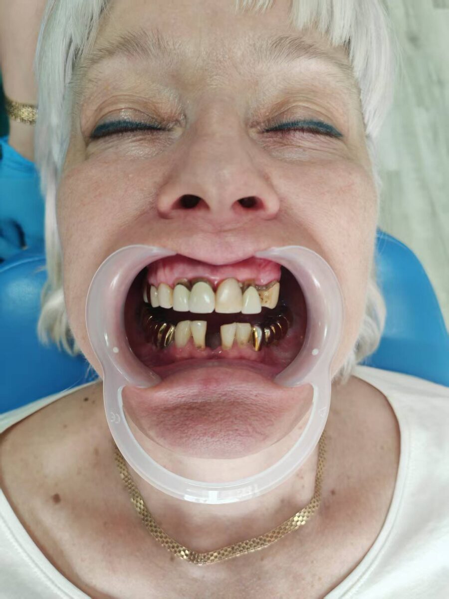 До протезирования зубов в Китае