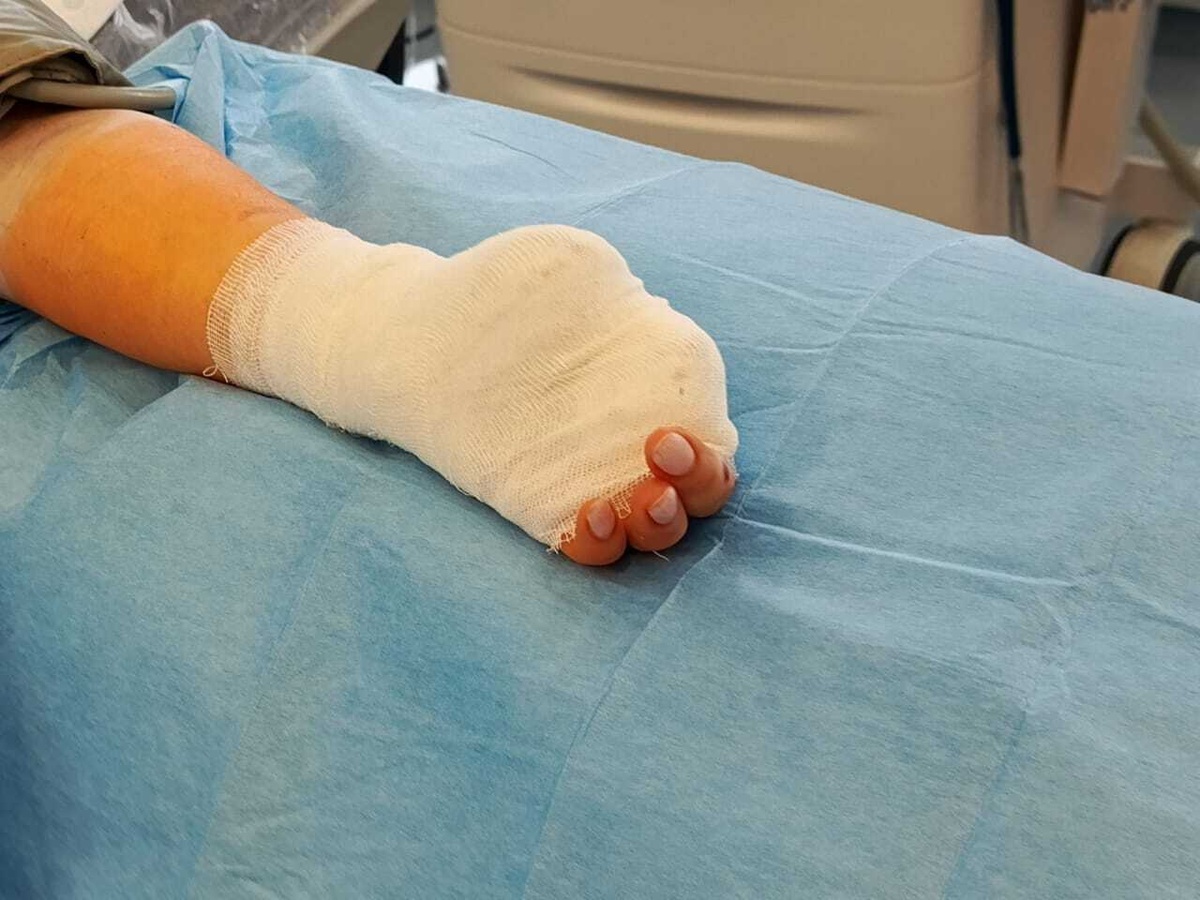    Жительнице Когалыма ампутировали пальцы после удара током от зарядки телефона