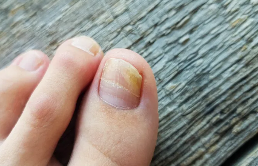Почему желтеют ногти на ногах и что с этим можно сделать?