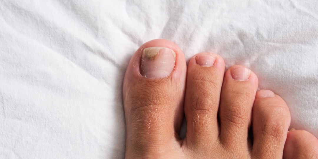 Лучшее лечение грибка ногтей на ногах: 5 самых эффективных вариантов