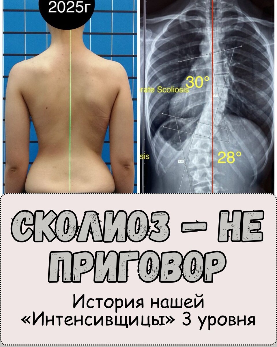 💪 Сколиоз — не приговор. История нашей «Интенсивщицы» 3 уровня