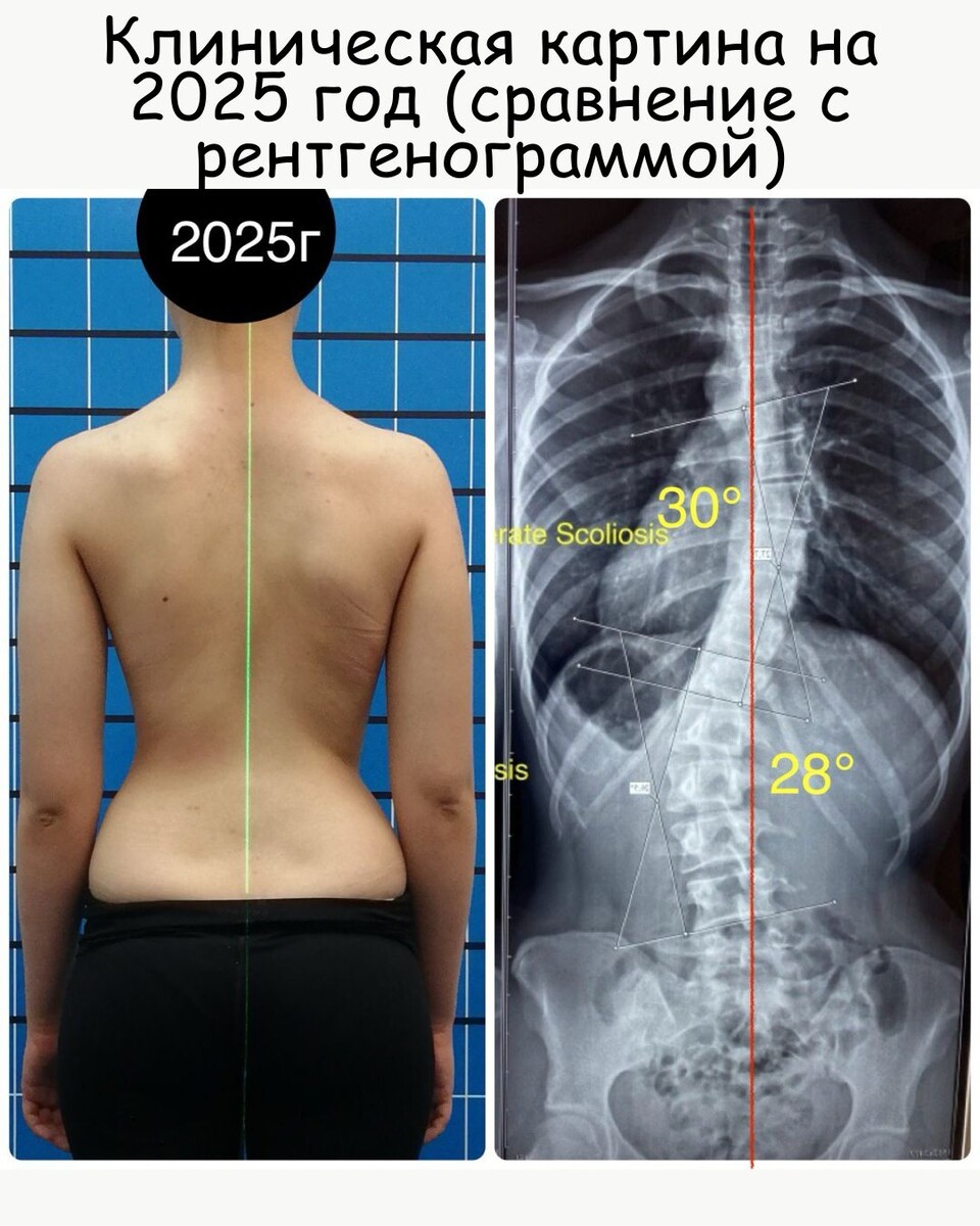 Результаты консервативной терапии в Сколио Центре