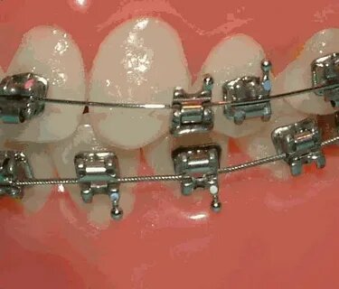 Брекет "висит" на дуге