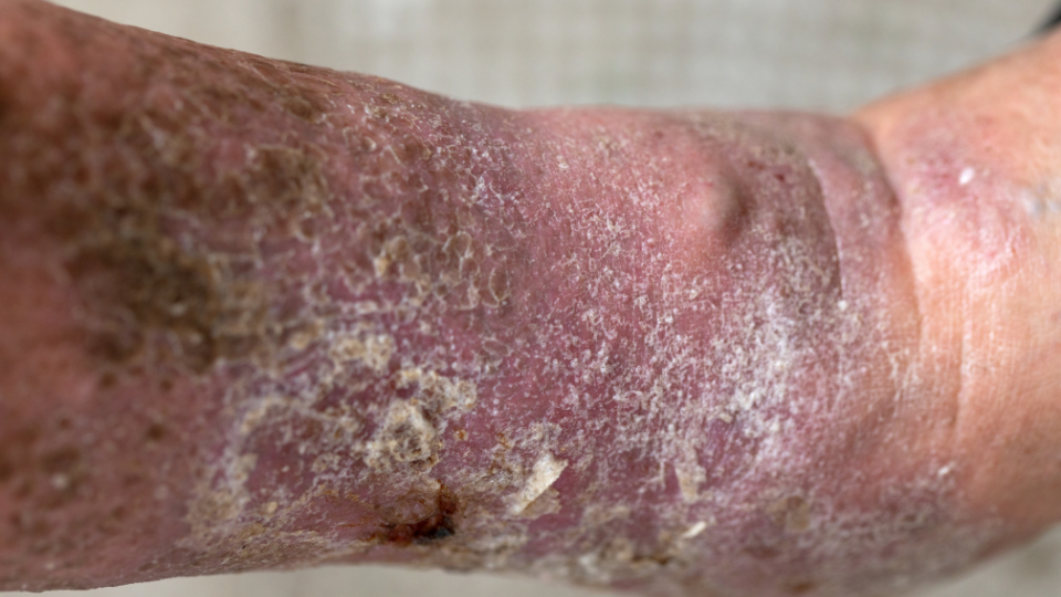 Варикозный дерматит