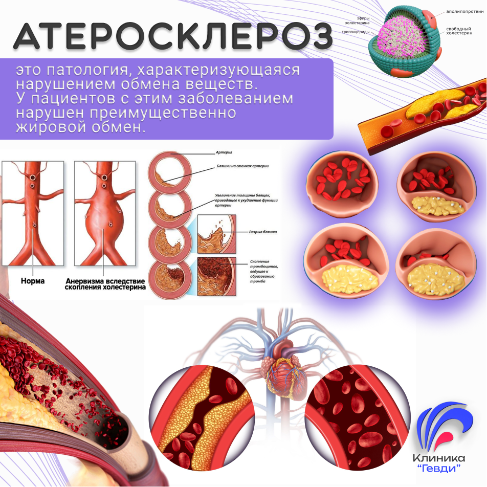 Атеросклероз – это заболевание, характеризующееся нарушением метаболизма, в частности липидного обмена. 