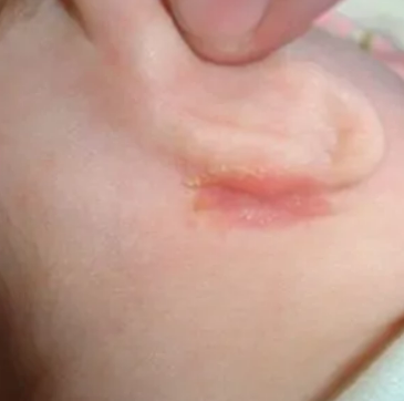 начальная стадия