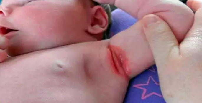 прогрессирующая стадия