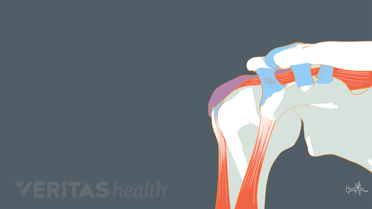 Формирование импиджмент синдрома плеча. Нормально работающая надосная мышца, должнасместить головки плеча вниз и увеличить пространство между плечевой костью и лопаткой.  