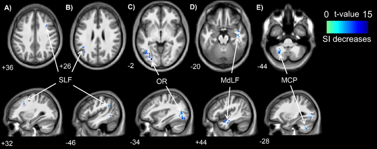    Местоположения значимых кластеров по электрическим свойствам, данным томографии между разными условиями.Sports Medicine—Open