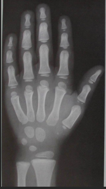 Мальчик, костный возраст 4 года.