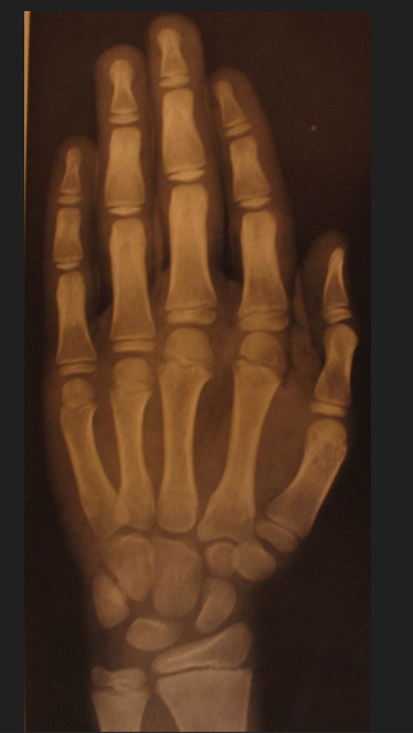 Мальчик, костный возраст 11 лет.