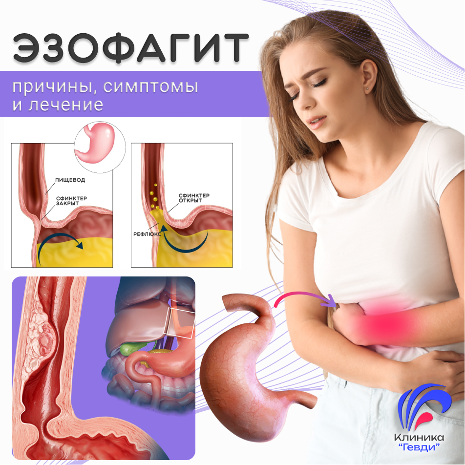 Эзофагит - причины, симптомы, лечение в Клинике "Гевди".
