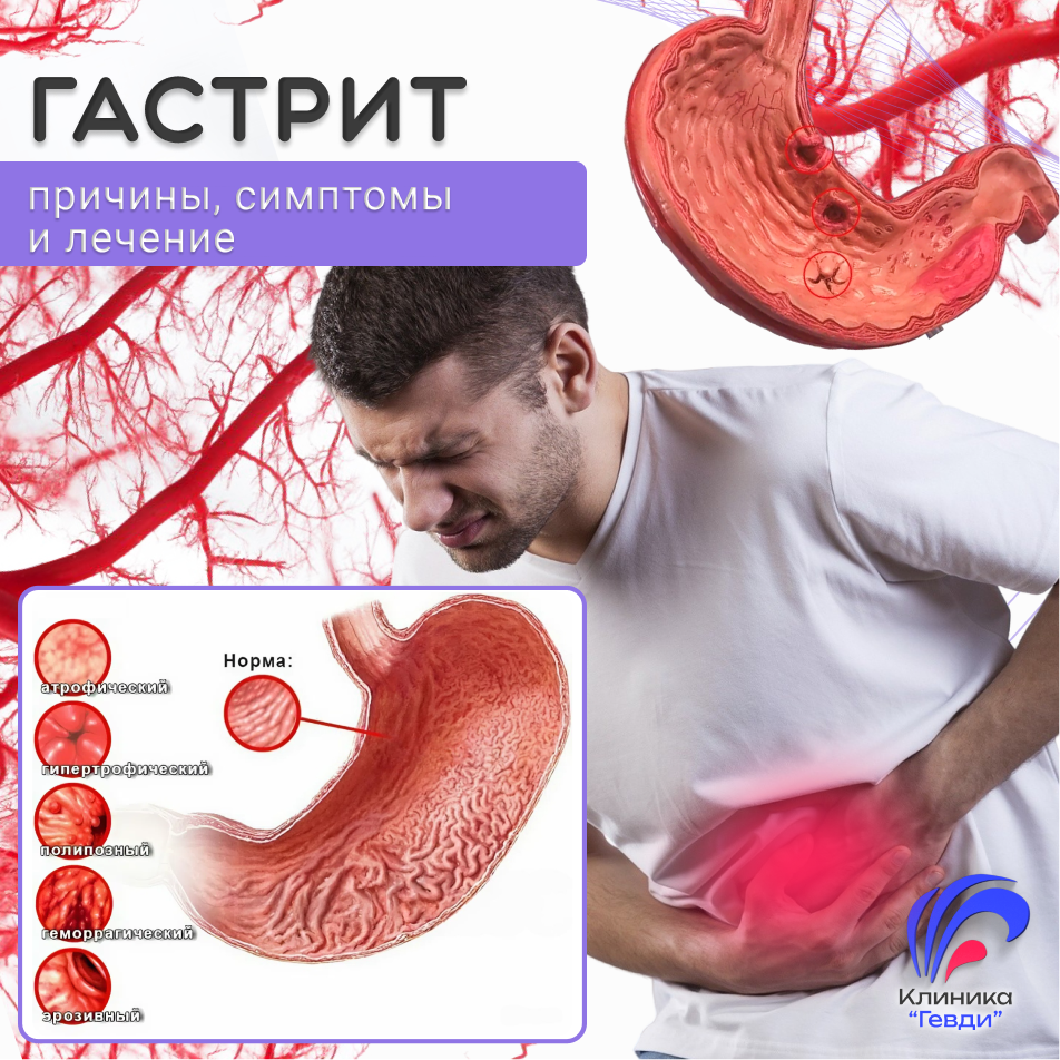Гастрит. Лечение Гастрита в Клинике "Гевди"