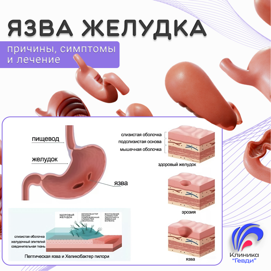 Язвенная болезнь желудка (ЯБЖ)