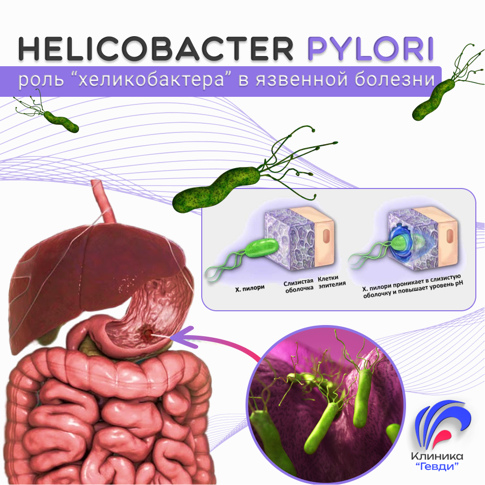 Роль Хеликобактера (Helicobacter pylori) в язвенной болезни.