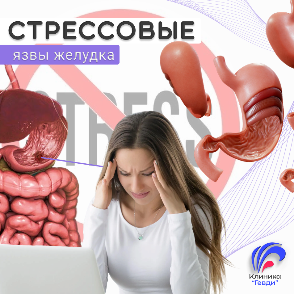 Стрессовые язвы желудка 