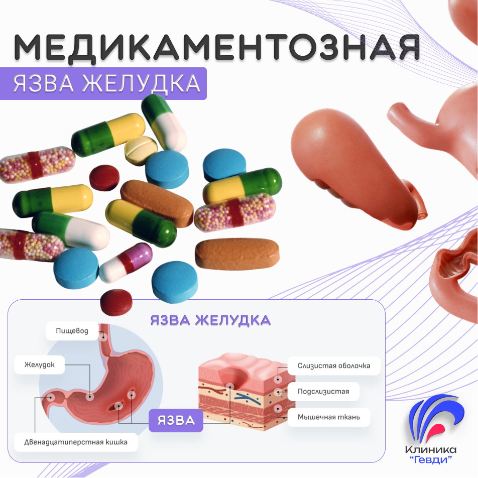 Медикаментозная (лекарственная) язва желудка