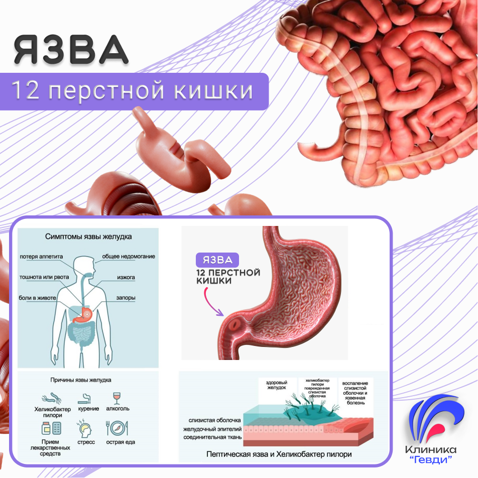Язва двенадцатиперстной кишки
