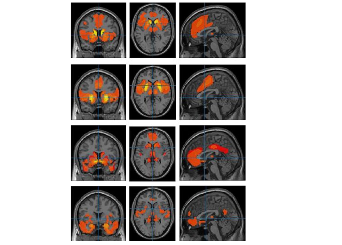 Национальный институт здравоохранения США📷МРТ мозга подростков с синдромом дефицита внимания и гиперактивности (СДВГ)