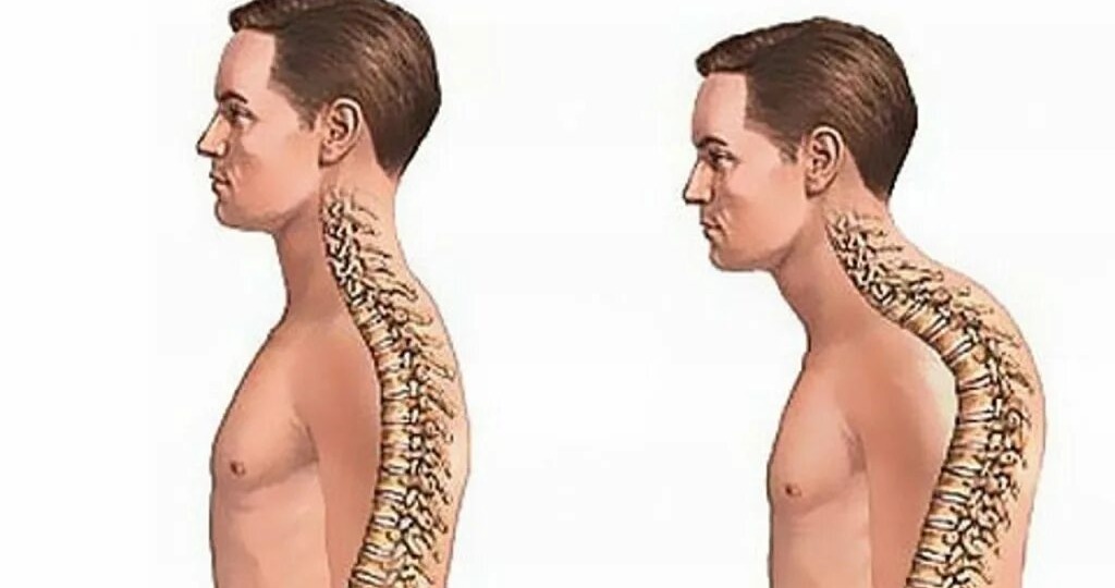 Как исправить сутулость: эффективные упражнения и важные рекомендации