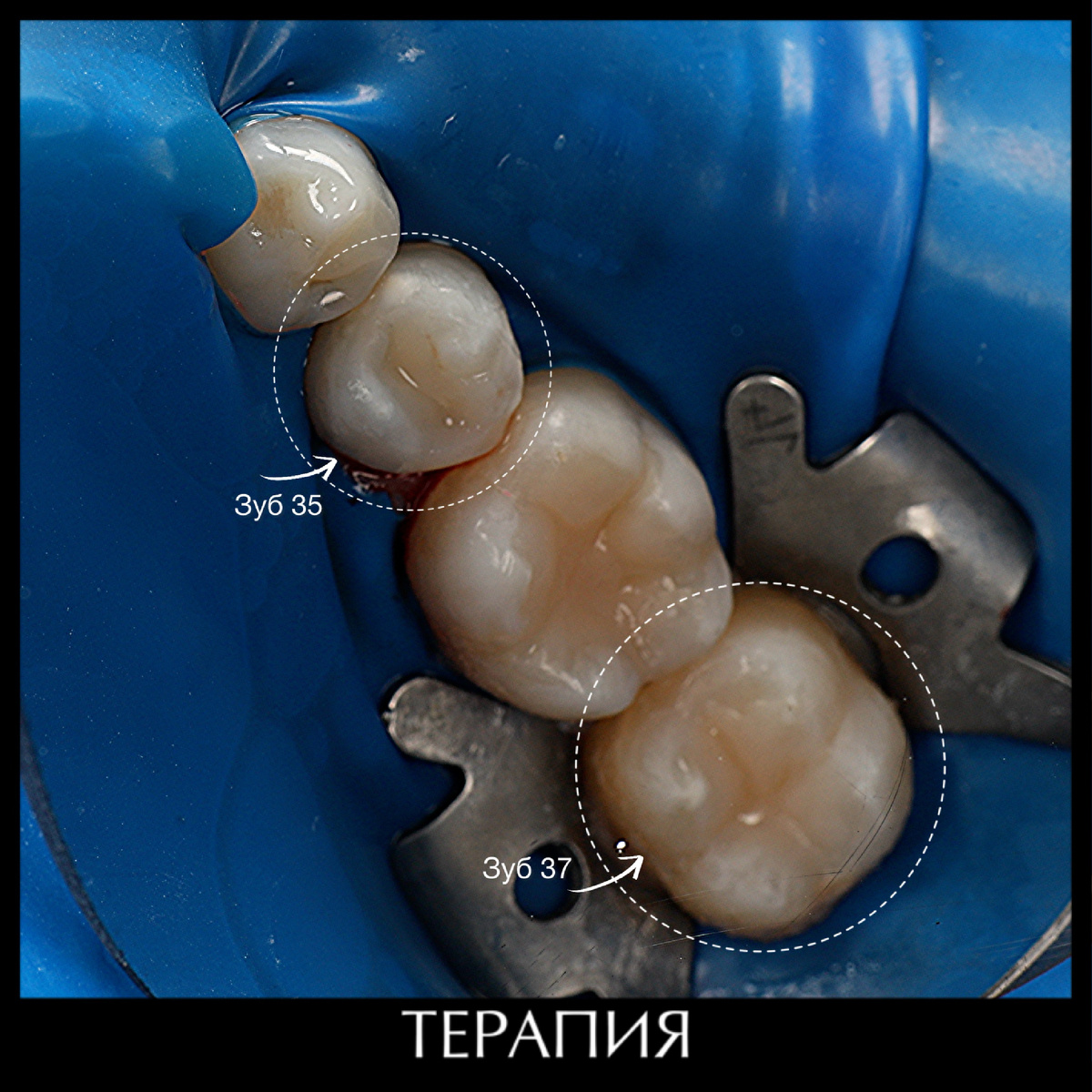 Лечение среднегот кариеса 35 и 37 зубов