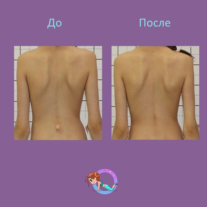 Результаты лечения!  💫💫
Пациентка К. 2011 г.р. обратилась на приём к врачу ортопеду к.м.н. Громову И.С. с жалобами на деформацию позвоночника. 
При осмотре поставлен диагноз: юношеский идиопатический сколиоз третьей степени. 🩻
Было пройдено лечение: корсетотерапия по методу Шено и гимнастика Шрот ✅  
На сегодняшний момент в корсете Шено угол деформации уменьшен с 27 до 7 градусов  💥💯
Коррекция в корсете 80%  🔥Так же получен хороший косметический результат❗💫