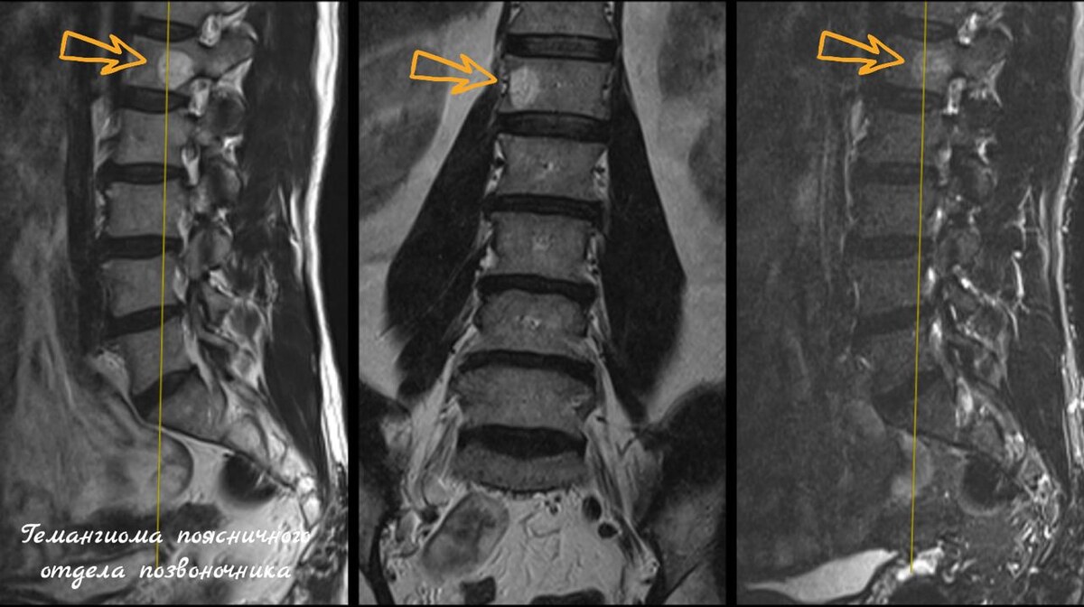 гемангиома поясничного отдела