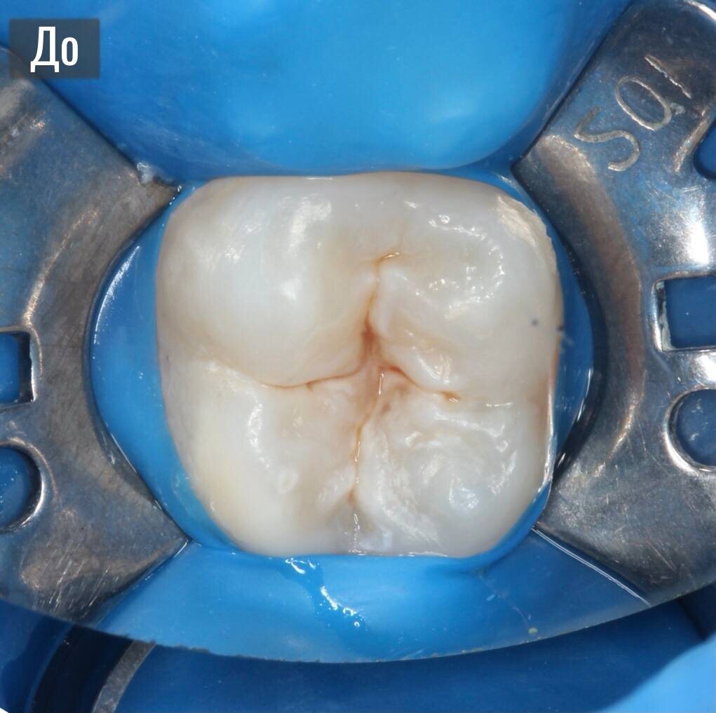 Фото зуба на момент обращения 