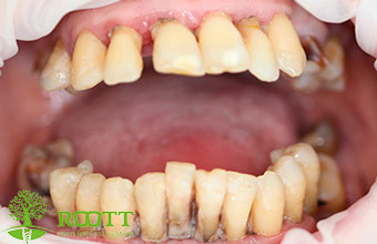 Пациент обратился в клинику с поражениями пародонта (пародонтозом). 