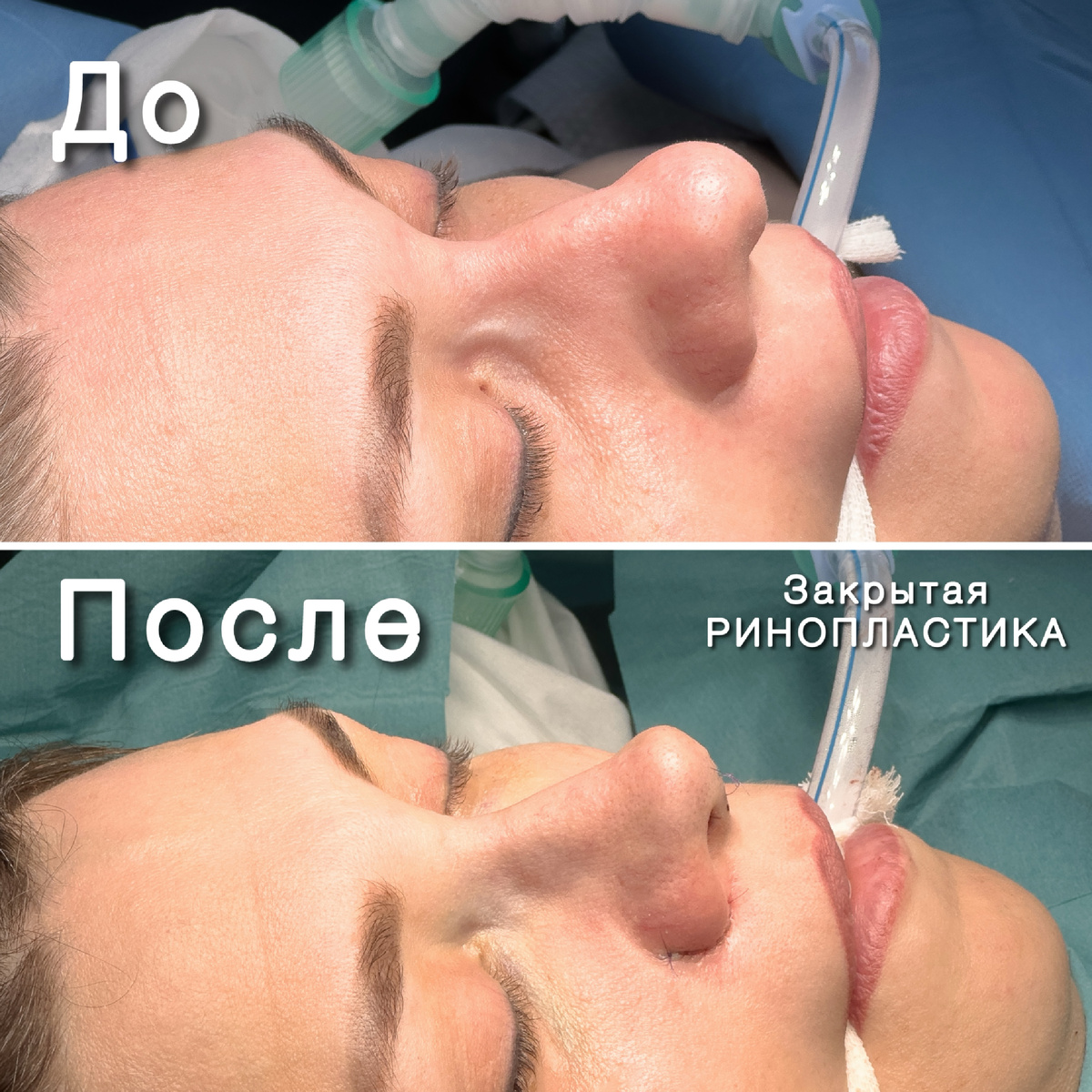 Закрытая ринопластика, пластический хирург Стайсупов В.Ю.