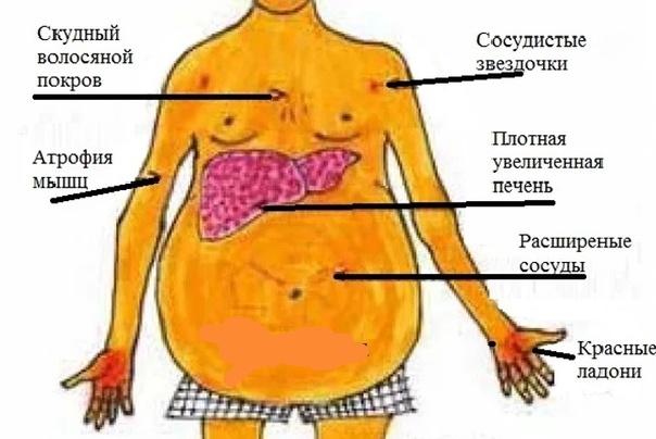 Характерный вид больного циррозом печени.