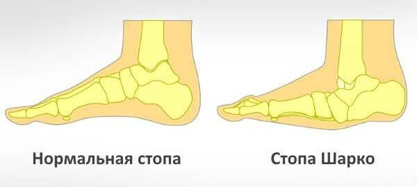 Стопа Шарко - тихий разрушитель ног при диабете!