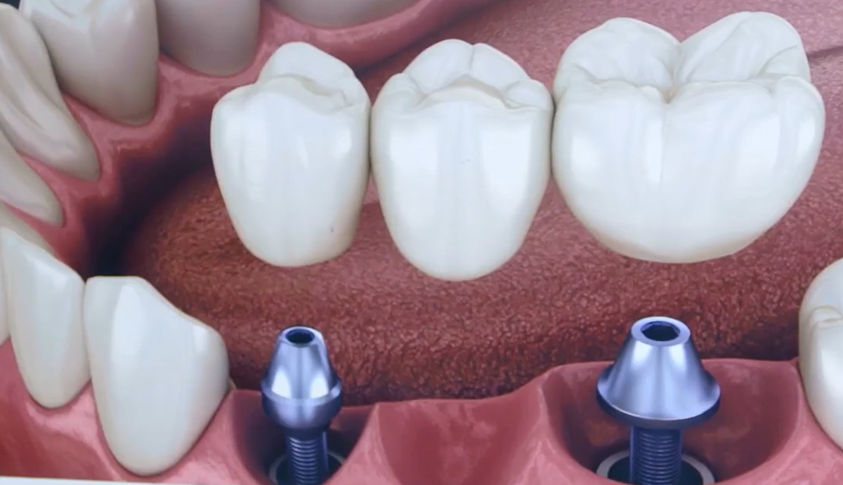 Мостовидный протез на имплантах